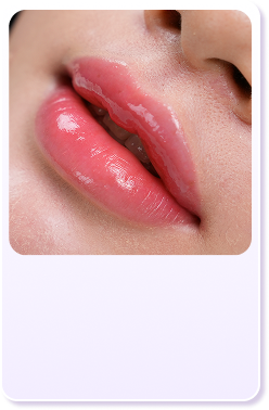 Cấy môi Diamond Lips