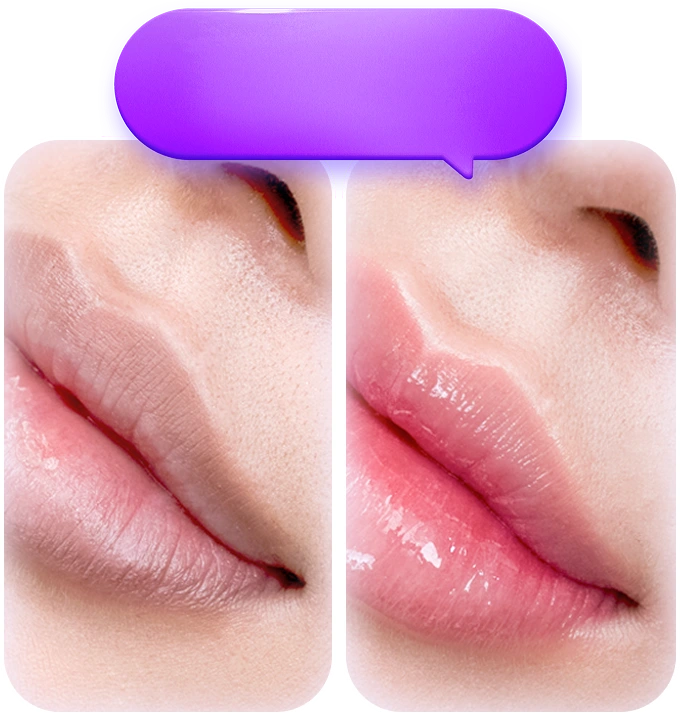 Phun môi collagen cải thiện môi thâm xỉn màu và môi nhợt nhạt