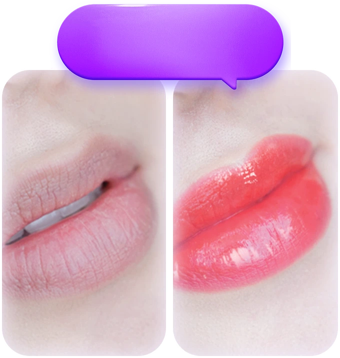 Phun môi collagen làm đầy rãnh môi và tái tạo môi căng bóng