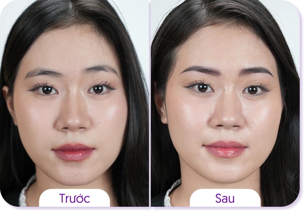Kết quả khách hàng phun mày Linh Anh trước và sau case 2