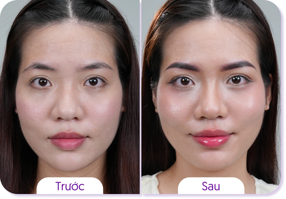 Kết quả khách hàng phun mày Linh Anh trước và sau case 4