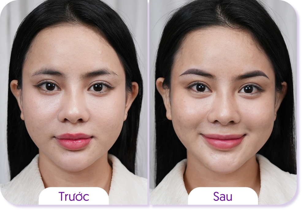 Kết quả khách hàng phun mày Linh Anh trước và sau case 5