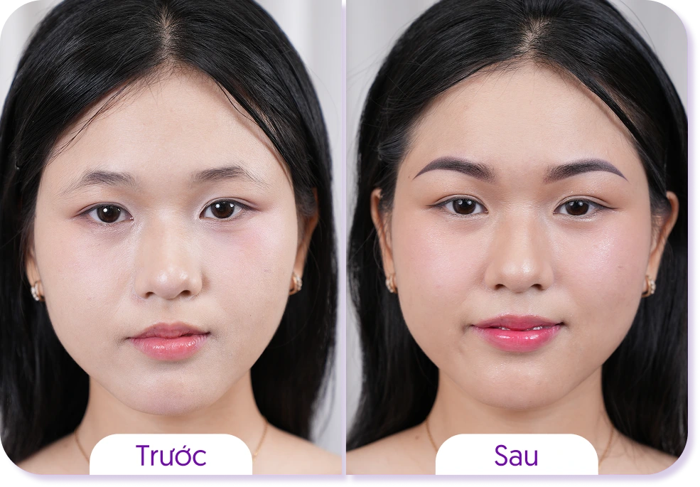Kết quả khách hàng phun mày Linh Anh trước và sau case 3