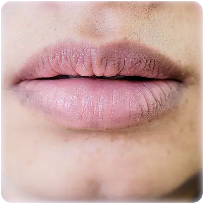 Tình trạng môi thâm, xỉn màu