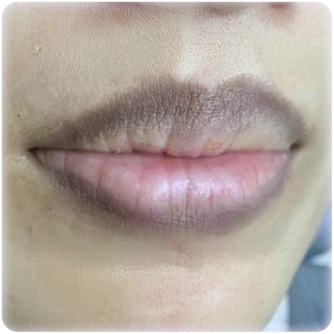 Tình trạng viền môi và lòng môi không đều màu, thâm viền môi