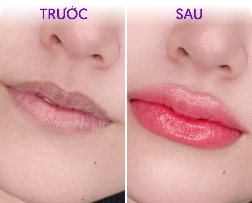 Trước và sau Phun môi Diamond Lips – Khách hàng Huệ Linh