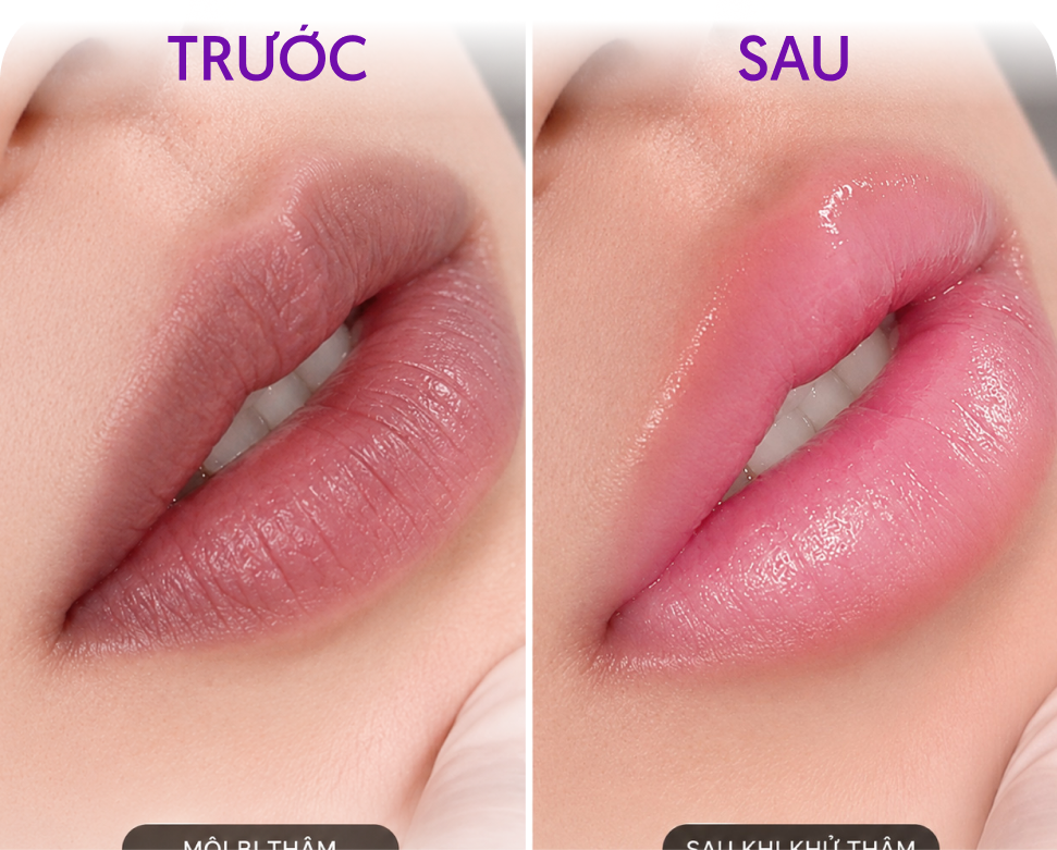 Trước và sau Khử thâm môi – Khách hàng Mỹ Linh