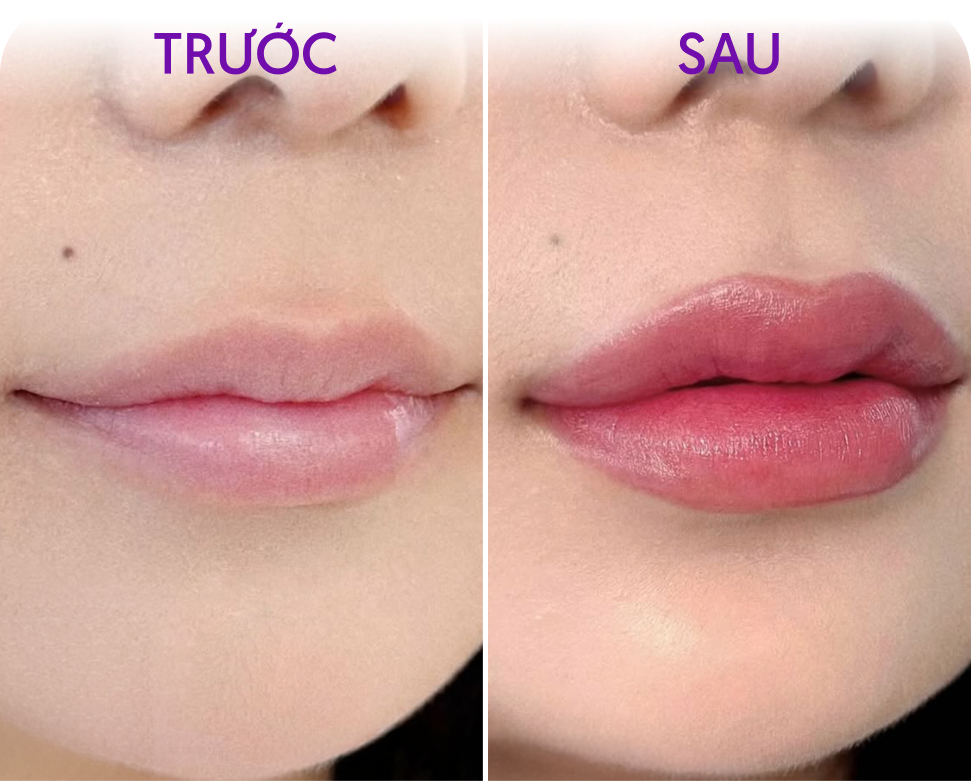 Trước và sau Phun môi WaterLips – Khách hàng Thùy Ngân