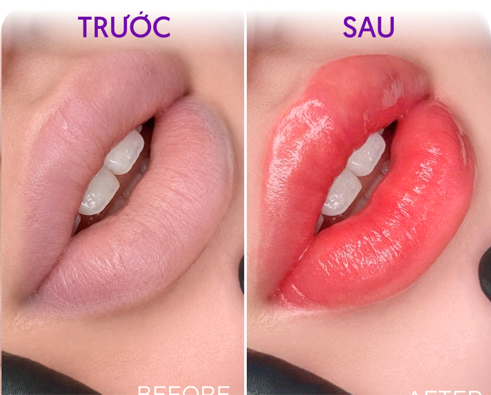 Trước và sau Phun môi WaterLips – Khách hàng Lan Hương