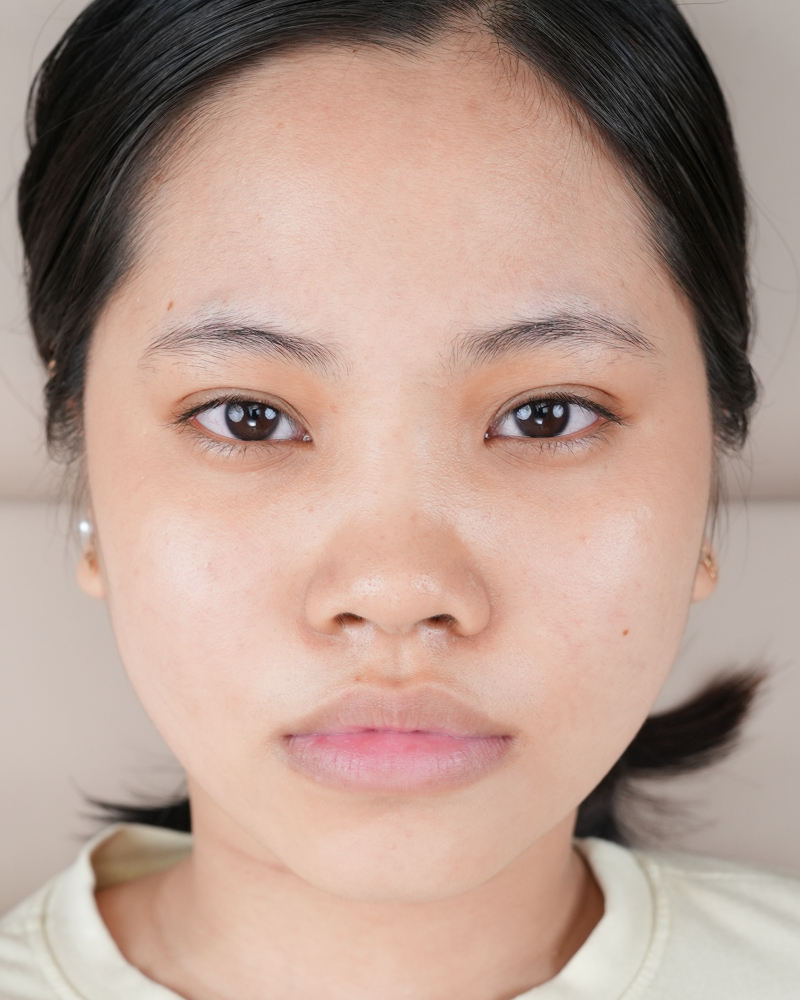 Khách hàng Minh Hồng – ảnh trước Phun môi