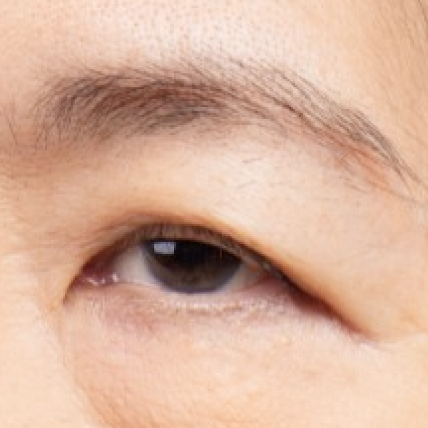 Đôi mắt một mí, mí lót hoặc mí sụp khiến ánh nhìn kém sắc
