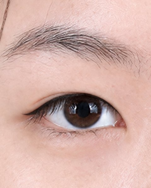 Mắt mí lót tại Thẩm mỹ Linh Anh