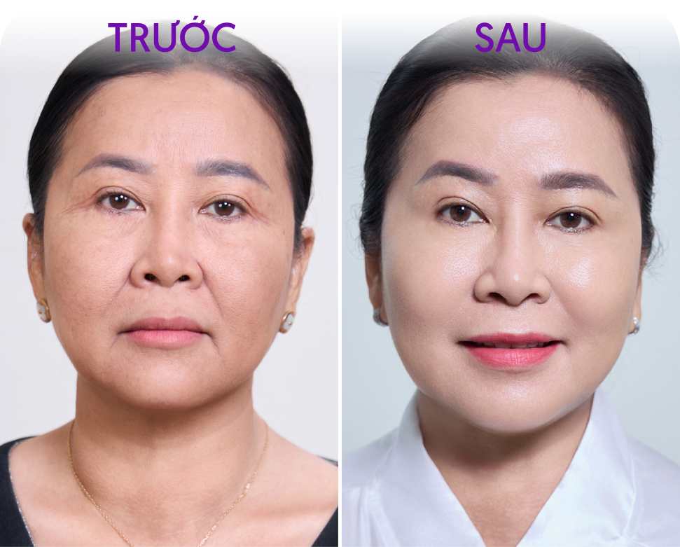 Trước và sau Trẻ hóa và xóa nhăn – khách hàng Trần Thị Vân, 55 tuổi, tại Thẩm mỹ Linh Anh