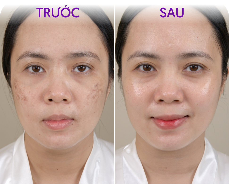 Trước và sau Laser CO₂ cải thiện nám – khách hàng Lê Thanh Loan, 43 tuổi, tại Thẩm mỹ Linh Anh