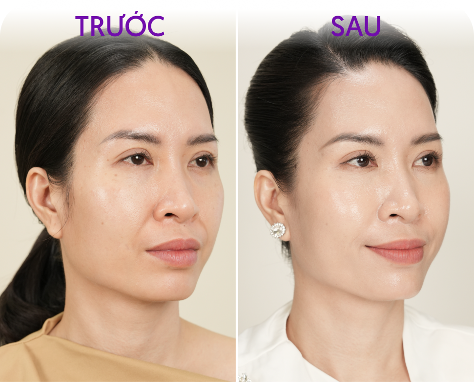 Trước và sau Làm săn chắc da – khách hàng Phạm Thị Ngọc Hạnh, 55 tuổi, tại Thẩm mỹ Linh Anh