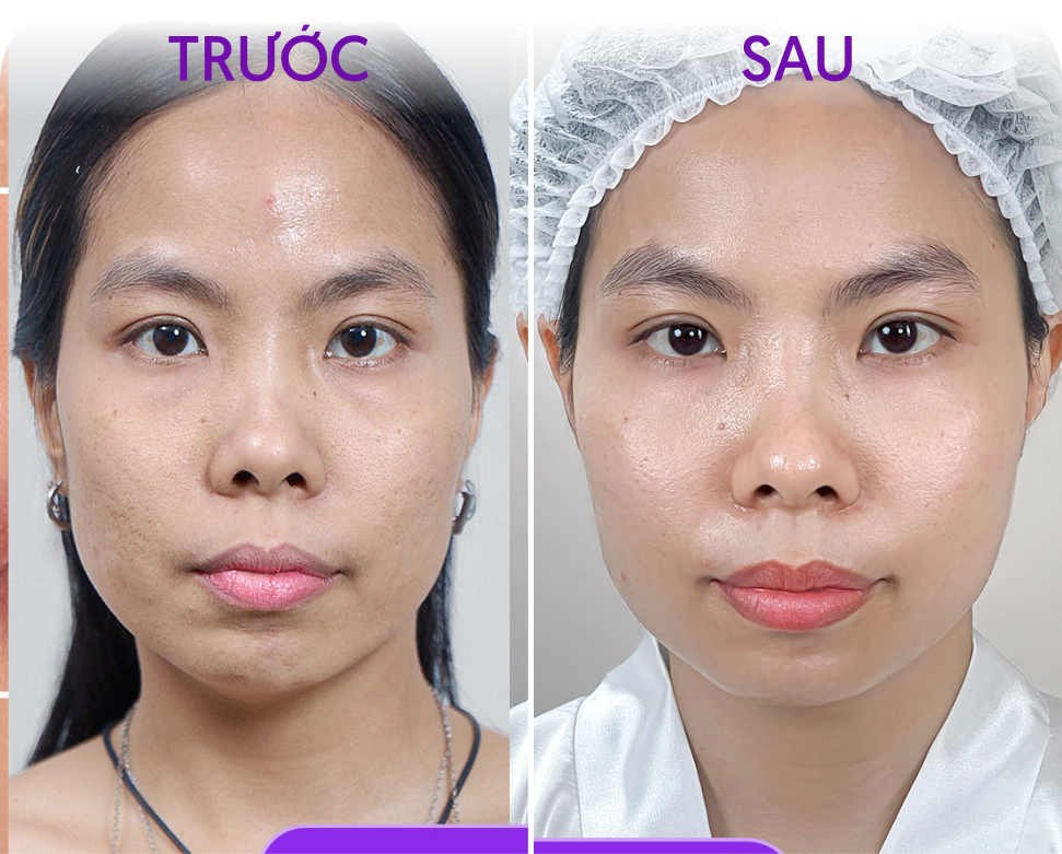 Trước và sau Meso phục hồi da – khách hàng Nguyễn Thùy Linh, 37 tuổi, tại Thẩm mỹ Linh Anh