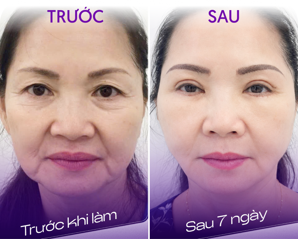 Trước và sau Combo treo cung mày và cắt mí – khách hàng Kim Liên, 63 tuổi, tại Thẩm mỹ Linh Anh