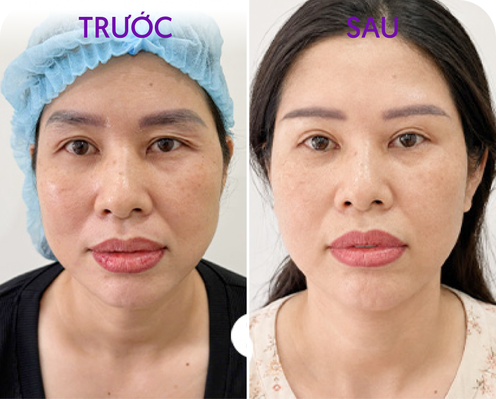Trước và sau Treo cung mày Browlift 5D – khách hàng Phạm Thị Lâm, 46 tuổi, tại Thẩm mỹ Linh Anh