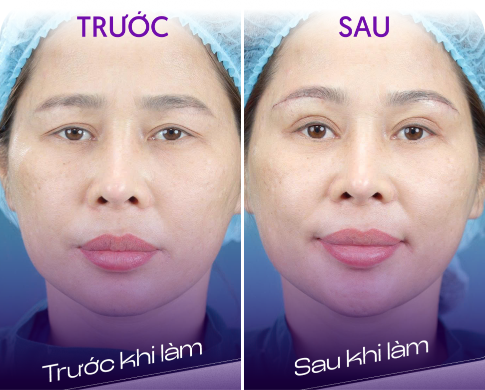 Trước và sau Combo treo cung mày và cắt mí – khách hàng Minh Thư, 47 tuổi, tại Thẩm mỹ Linh Anh