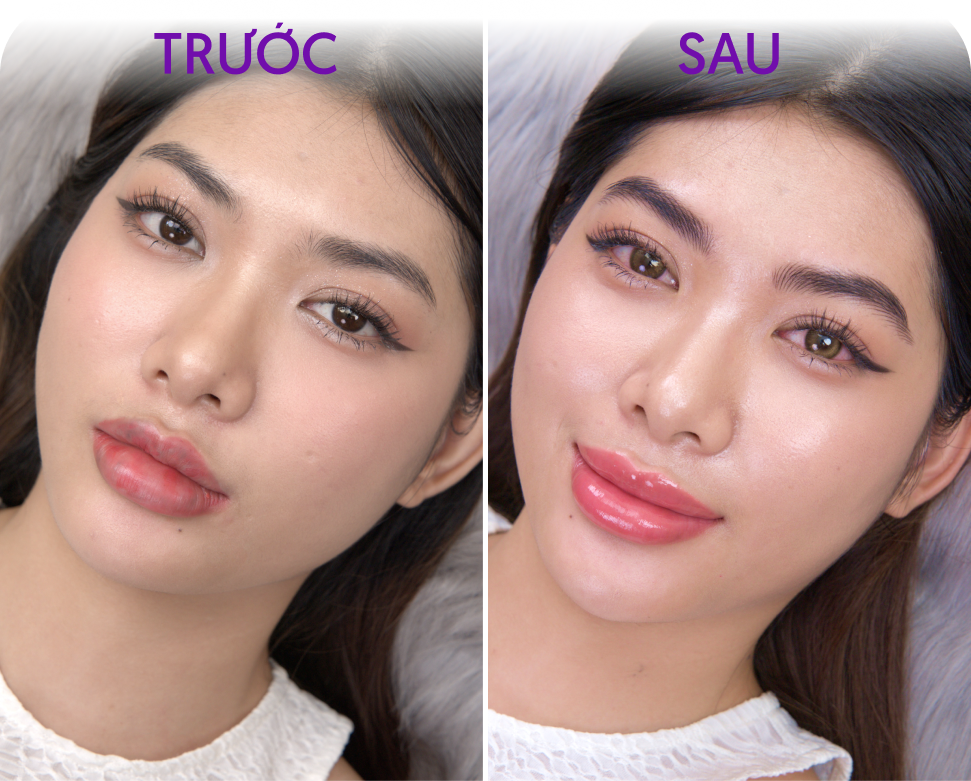 Trước và sau Phun môi Diamond Lips – khách hàng Minh Anh, 32 tuổi, tại Thẩm mỹ Linh Anh