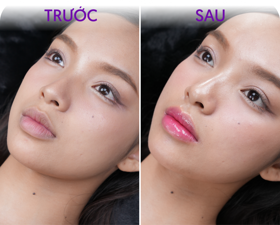 Trước và sau Phun môi WaterLips – khách hàng Ngọc Mai, 28 tuổi, tại Thẩm mỹ Linh Anh
