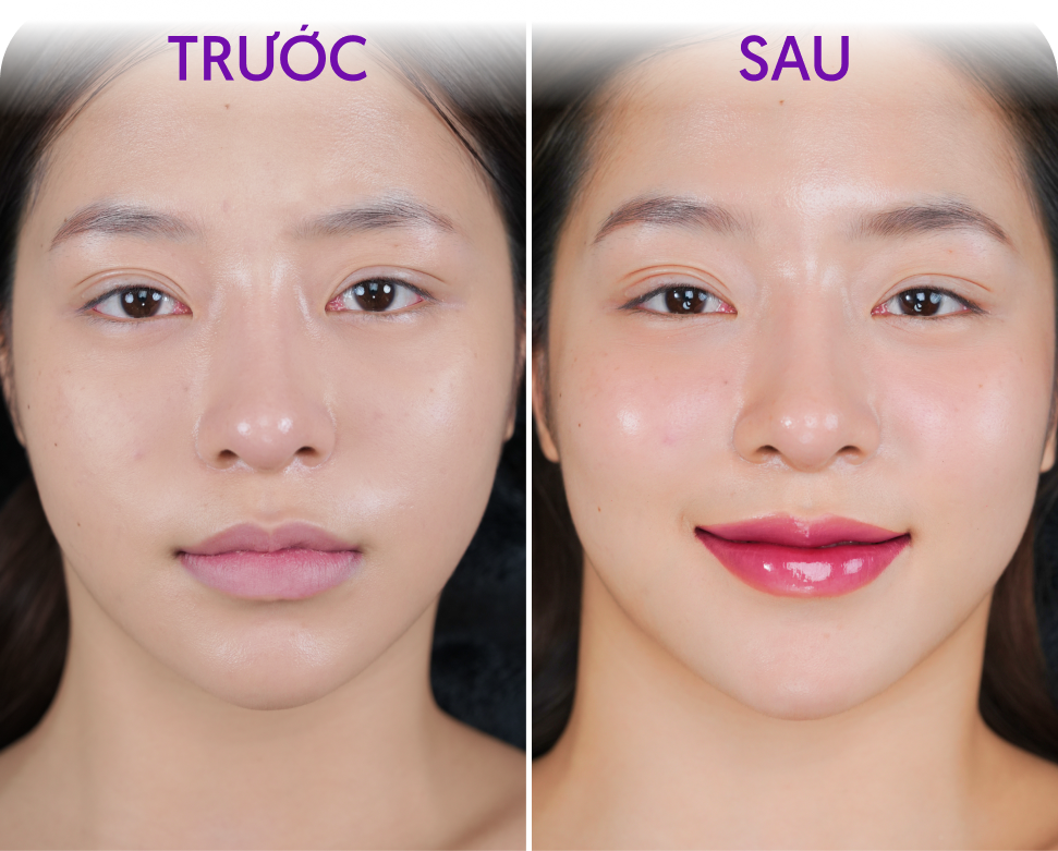 Trước và sau Phun môi Personal 4K Colors – khách hàng Thanh Hương, 32 tuổi, tại Thẩm mỹ Linh Anh