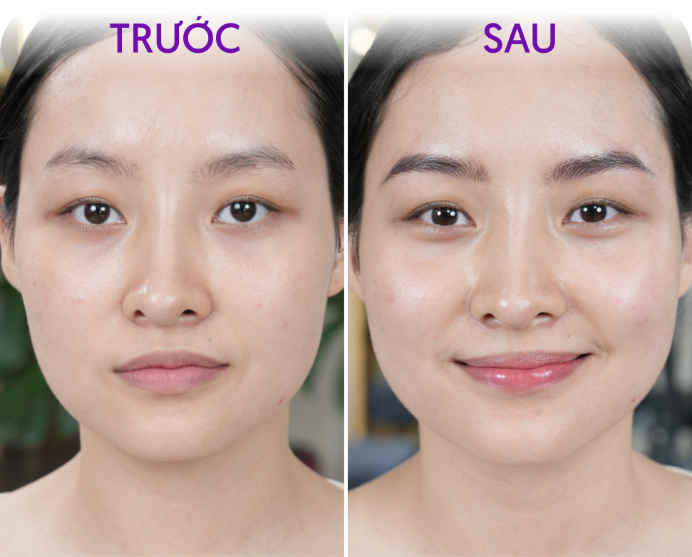 Trước và sau Hairstroke Siêu sợi – khách hàng Phạm Thu Hà, 35 tuổi, tại Thẩm mỹ Linh Anh
