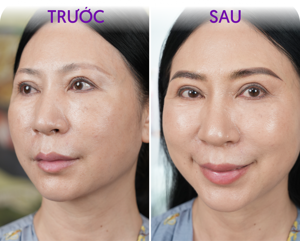 Trước và sau Vi Sợi Shading – khách hàng Mỹ Linh, 40 tuổi, tại Thẩm mỹ Linh Anh
