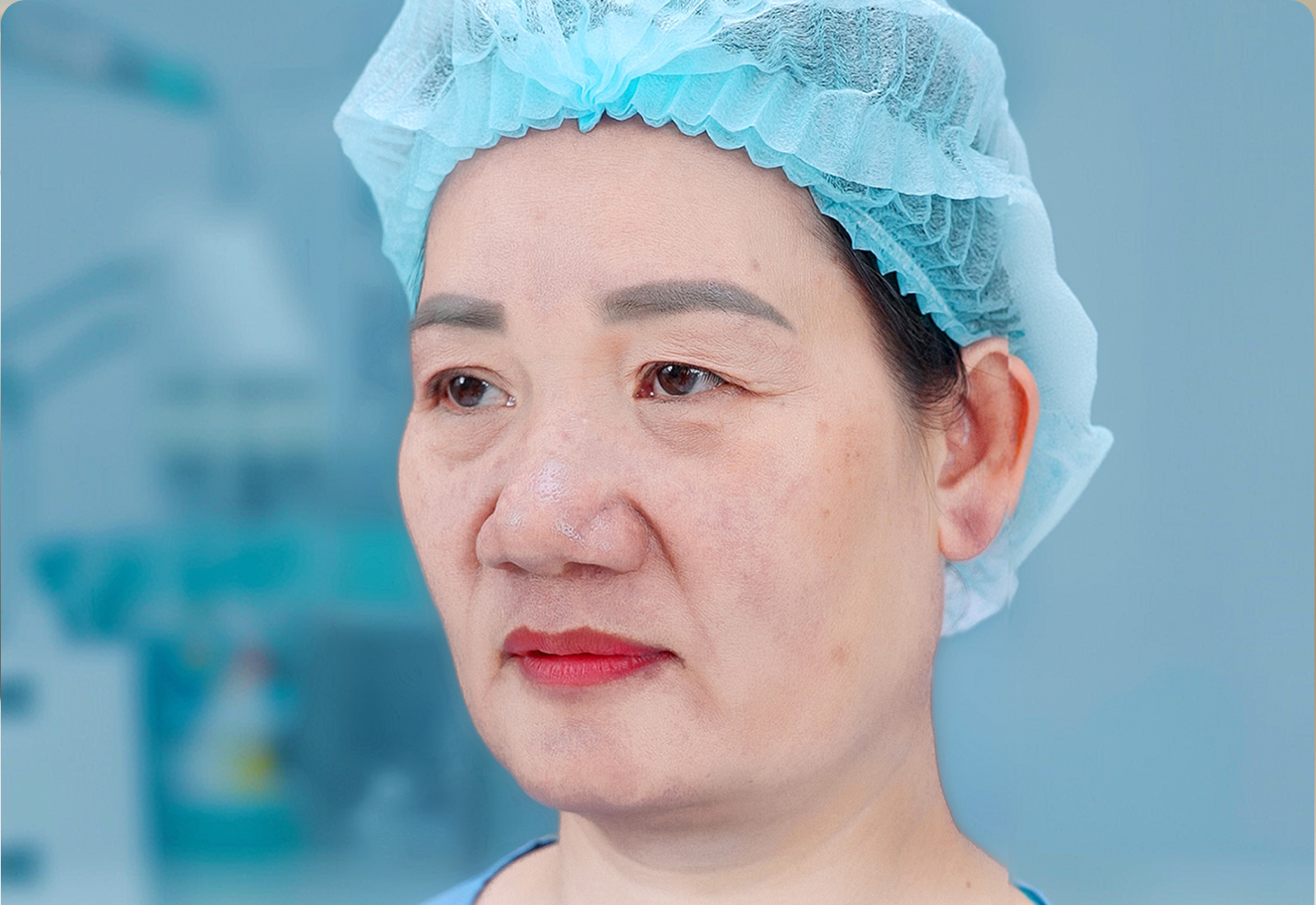 Trước phẫu thuật – khách hàng Thu Hà, Treo cung mày BrowLift 5D