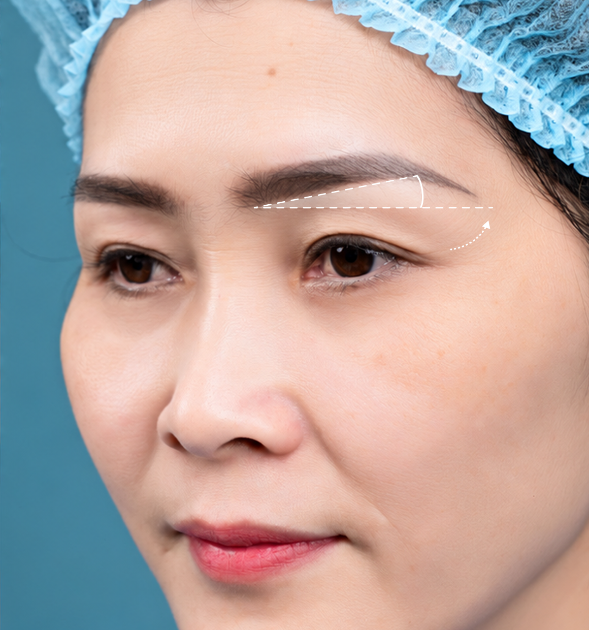 Minh họa treo cung mày BrowLift 5D – nâng cung mày, xử lý mỡ và da thừa