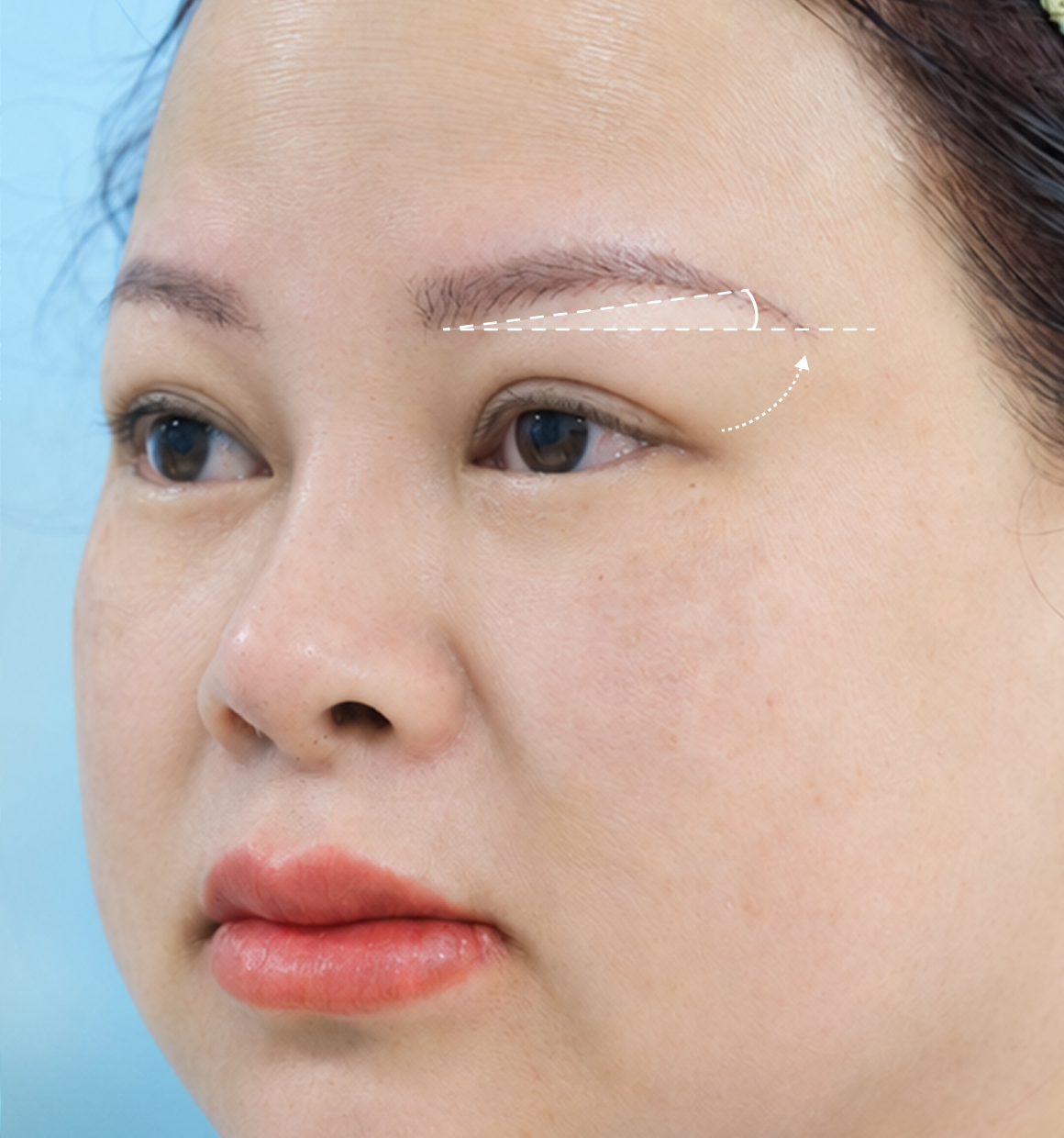 Minh họa treo cung mày mini BrowLift 5D với đường mổ ngắn sát đuôi chân mày