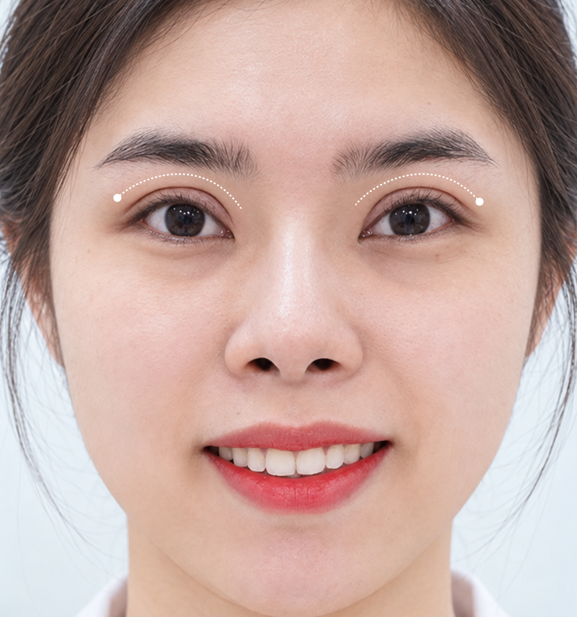 Minh họa cắt mí DeepEyes 5D tạo đường mí rõ nét, cân đối