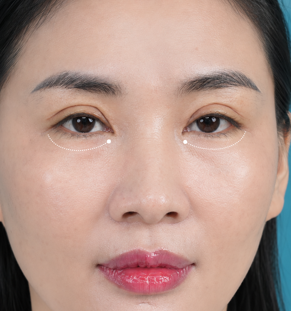 Minh họa cắt mí dưới Under Eyes loại bỏ bọng mỡ và da thừa mí dưới