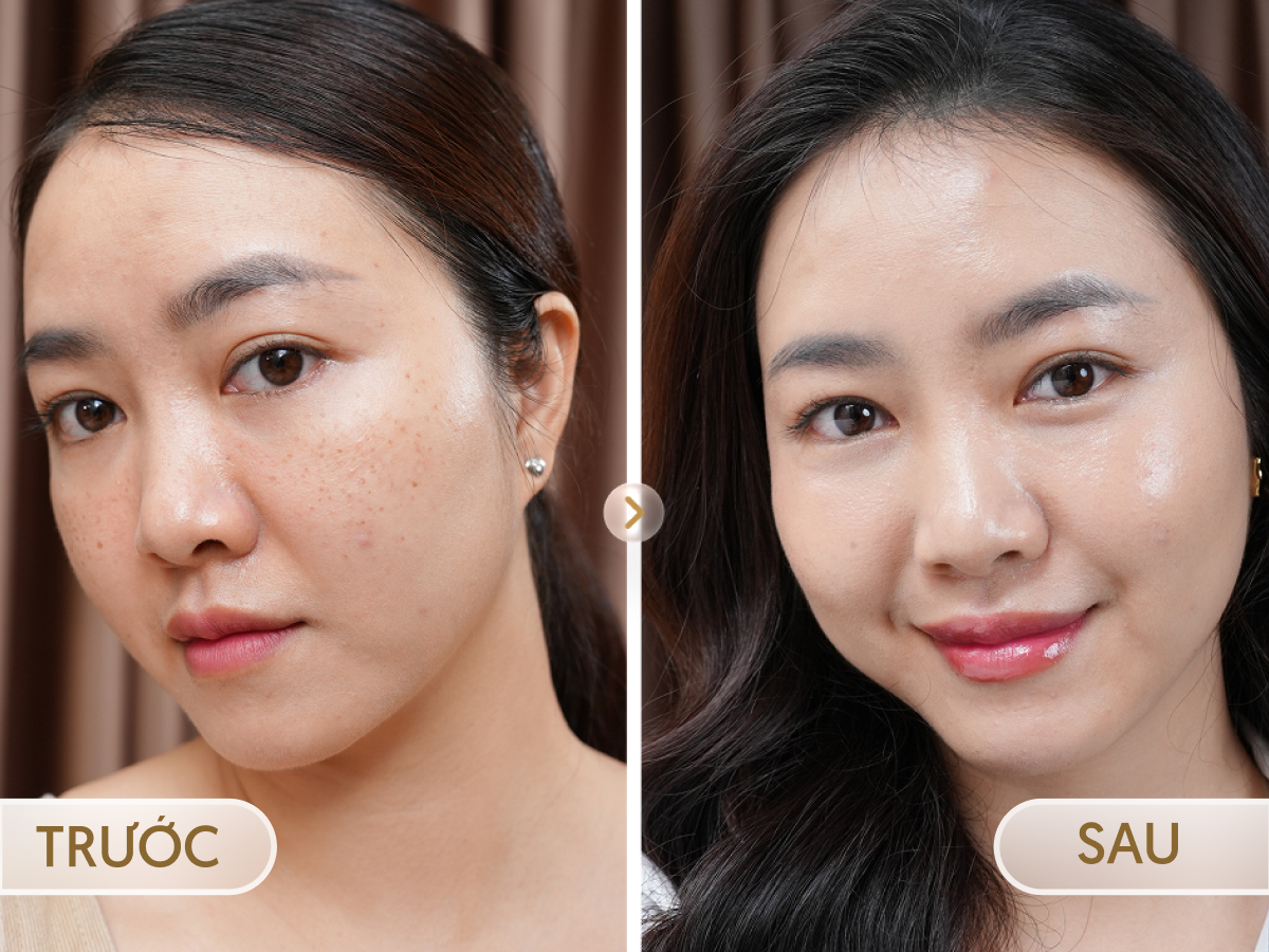 Trước và sau khi điều trị Laser Toning Min: Thu Hà, 34 tuổi