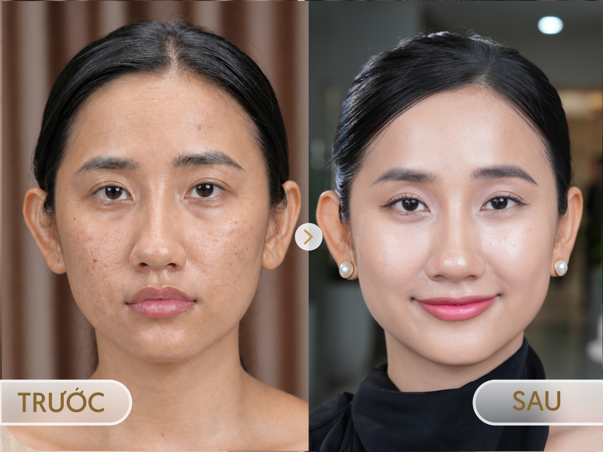 Trước và sau khi điều trị Laser Fotona: Ngọc Anh, 38 tuổi