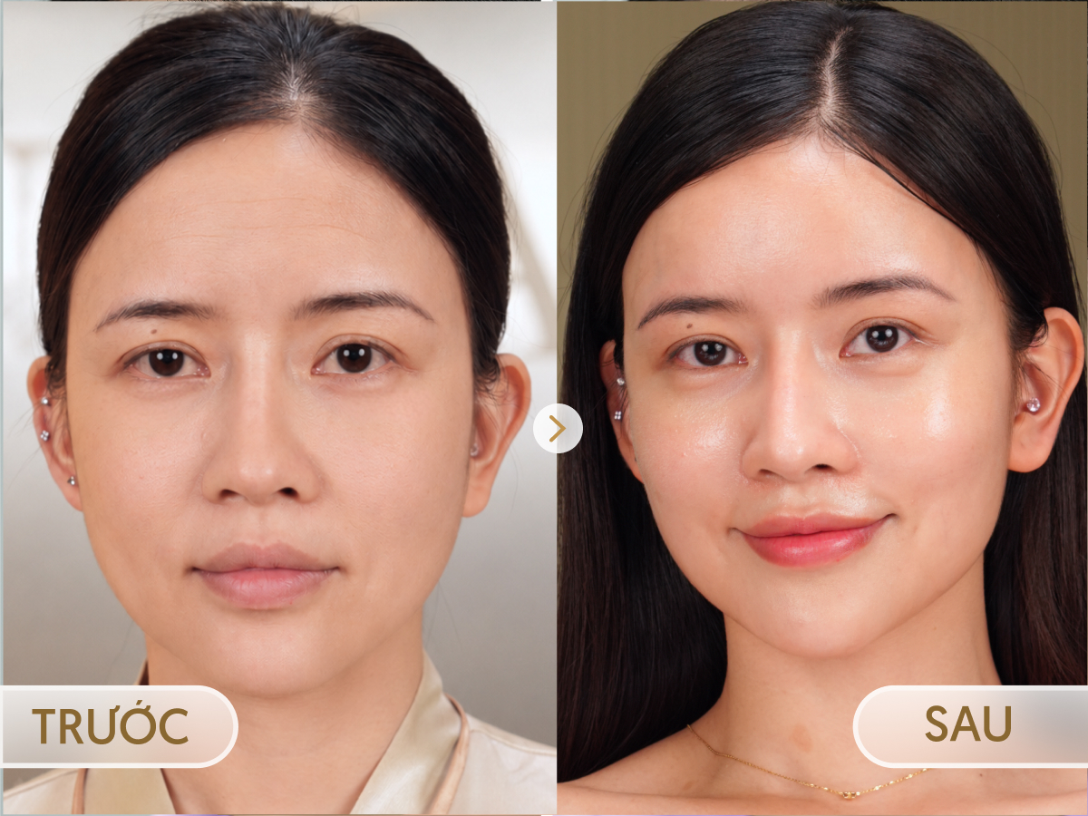 Trước và sau khi điều trị Meso Căng bóng: Thảo My, 27 tuổi