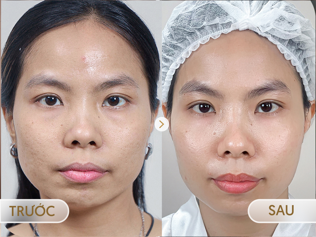 Trước và sau khi điều trị Meso Trắng sáng: Bảo Ngọc, 31 tuổi
