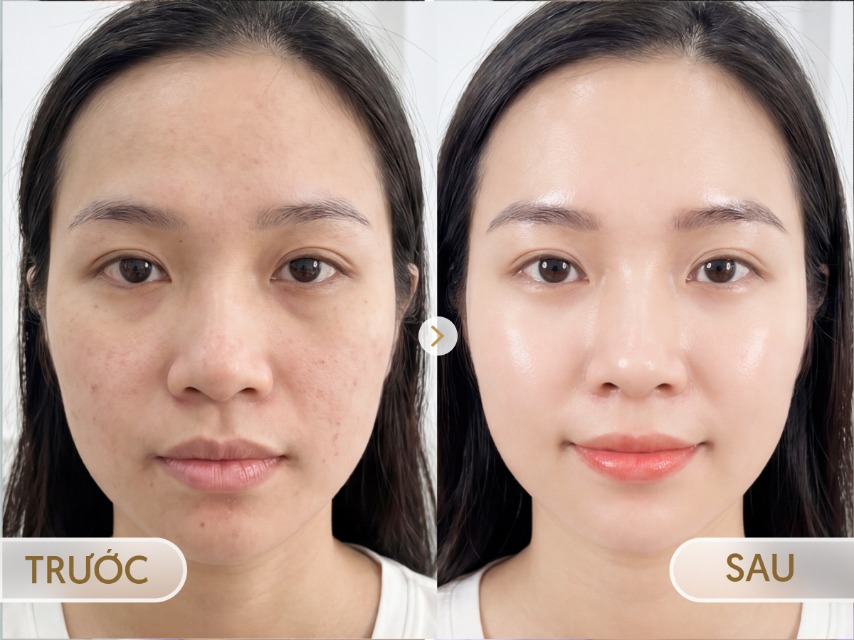 Trước và sau khi điều trị Meso Trắng sáng: Khánh Linh, 28 tuổi