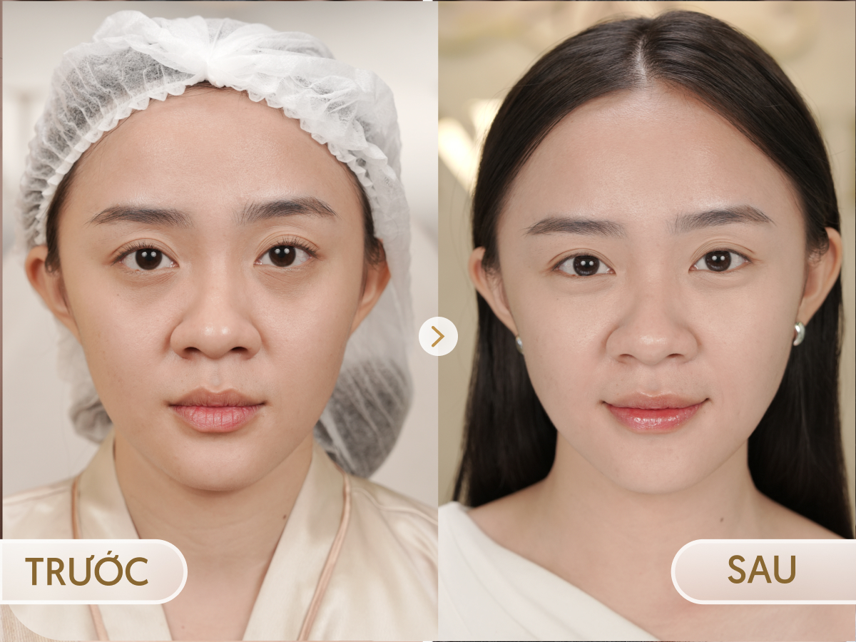 Trước và sau khi điều trị Meso Trẻ hóa mắt: Thuỳ Dương, 36 tuổi