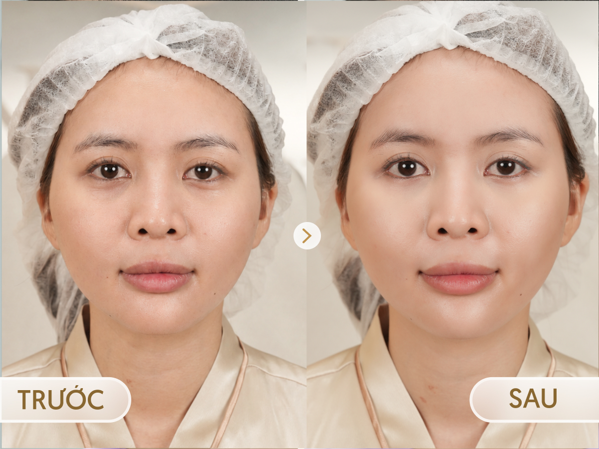 Trước và sau khi điều trị Meso Trẻ hóa mắt: Phương Anh, 40 tuổi