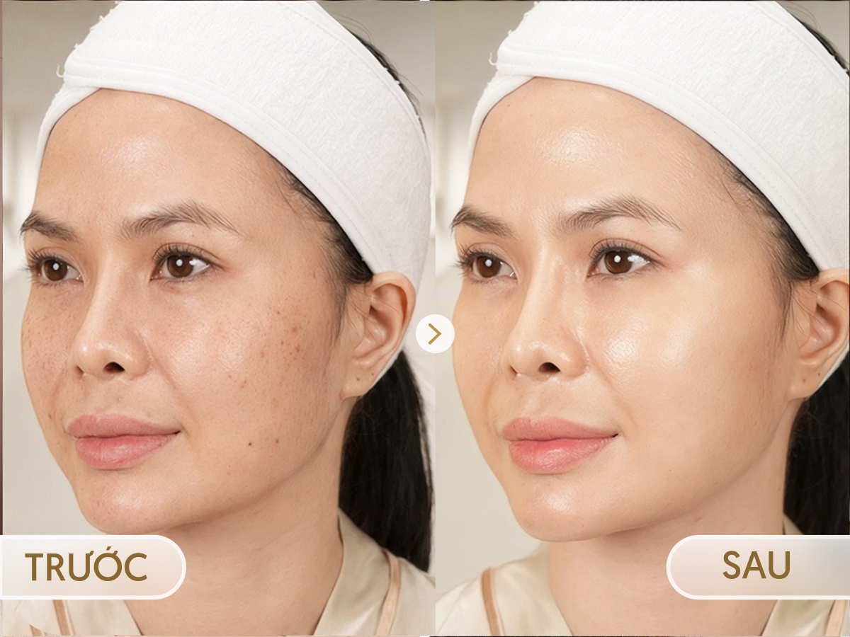 Trước và sau khi điều trị Mela - Zero: Hồng Hạnh, 42 tuổi