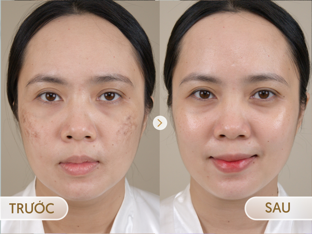 Trước và sau khi điều trị Mela - Zero: Thu Trang, 37 tuổi