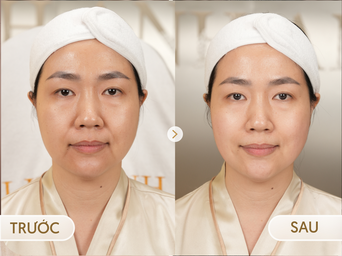 Trước và sau khi điều trị HIFU: Ngọc Mai, 45 tuổi