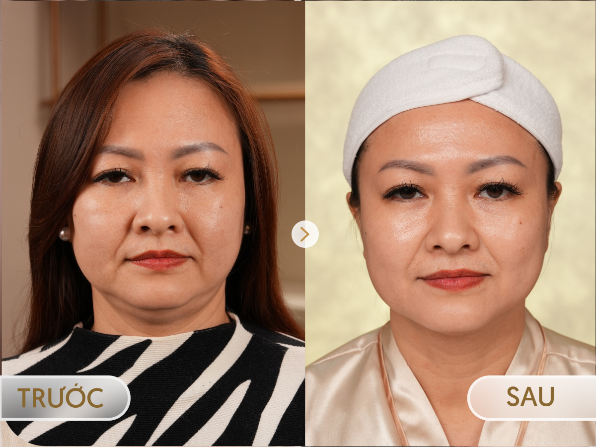 Trước và sau khi điều trị CFU ÈLIFE: Mỹ Linh, 53 tuổi