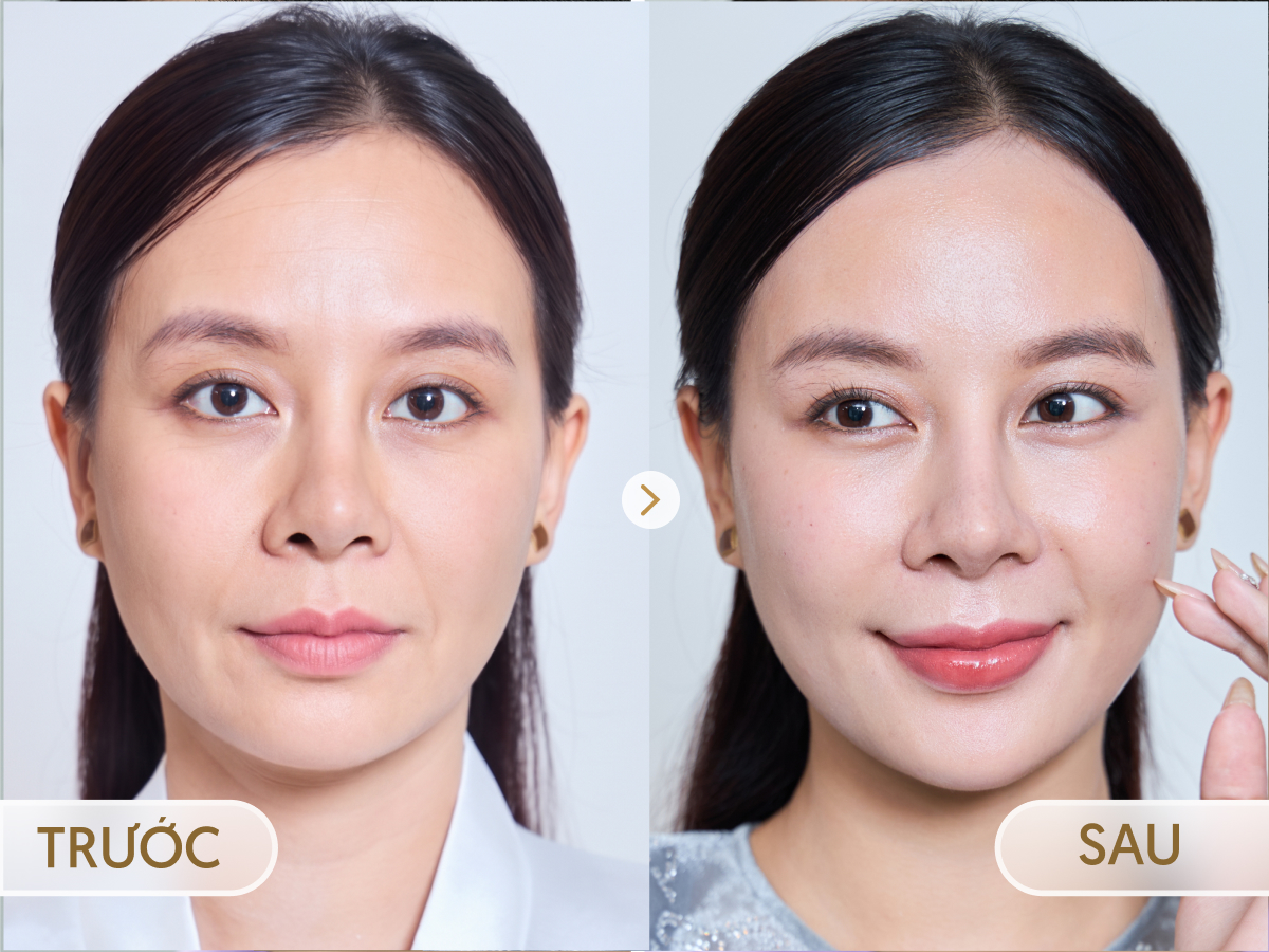 Trước và sau khi điều trị CFU ÈLIFE: Thu Phương, 39 tuổi