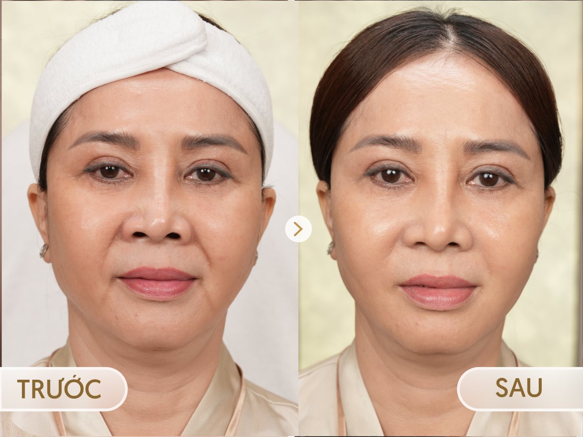 Trước và sau khi điều trị Ultherapy Prime: Bích Ngọc, 66 tuổi