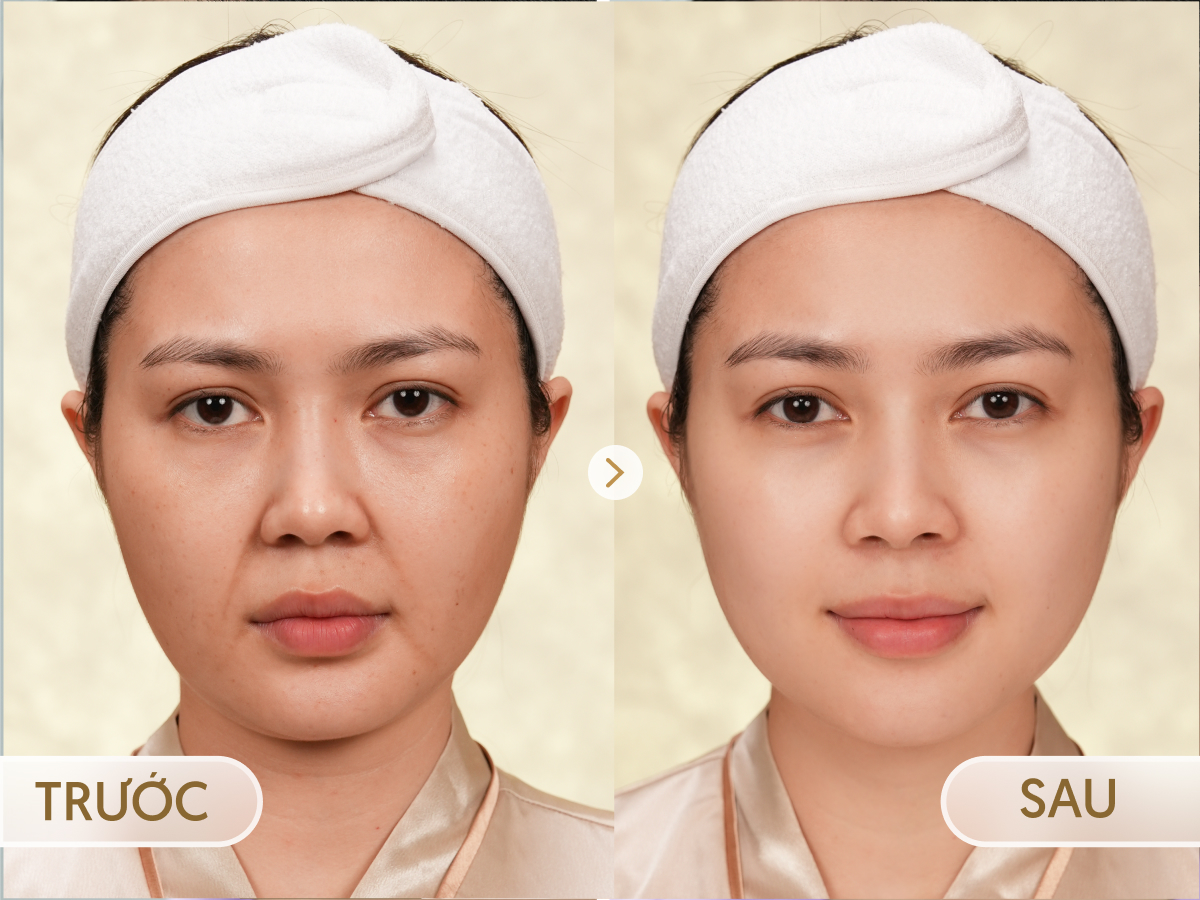 Trước và sau khi điều trị Ultherapy Prime: Hà My, 42 tuổi