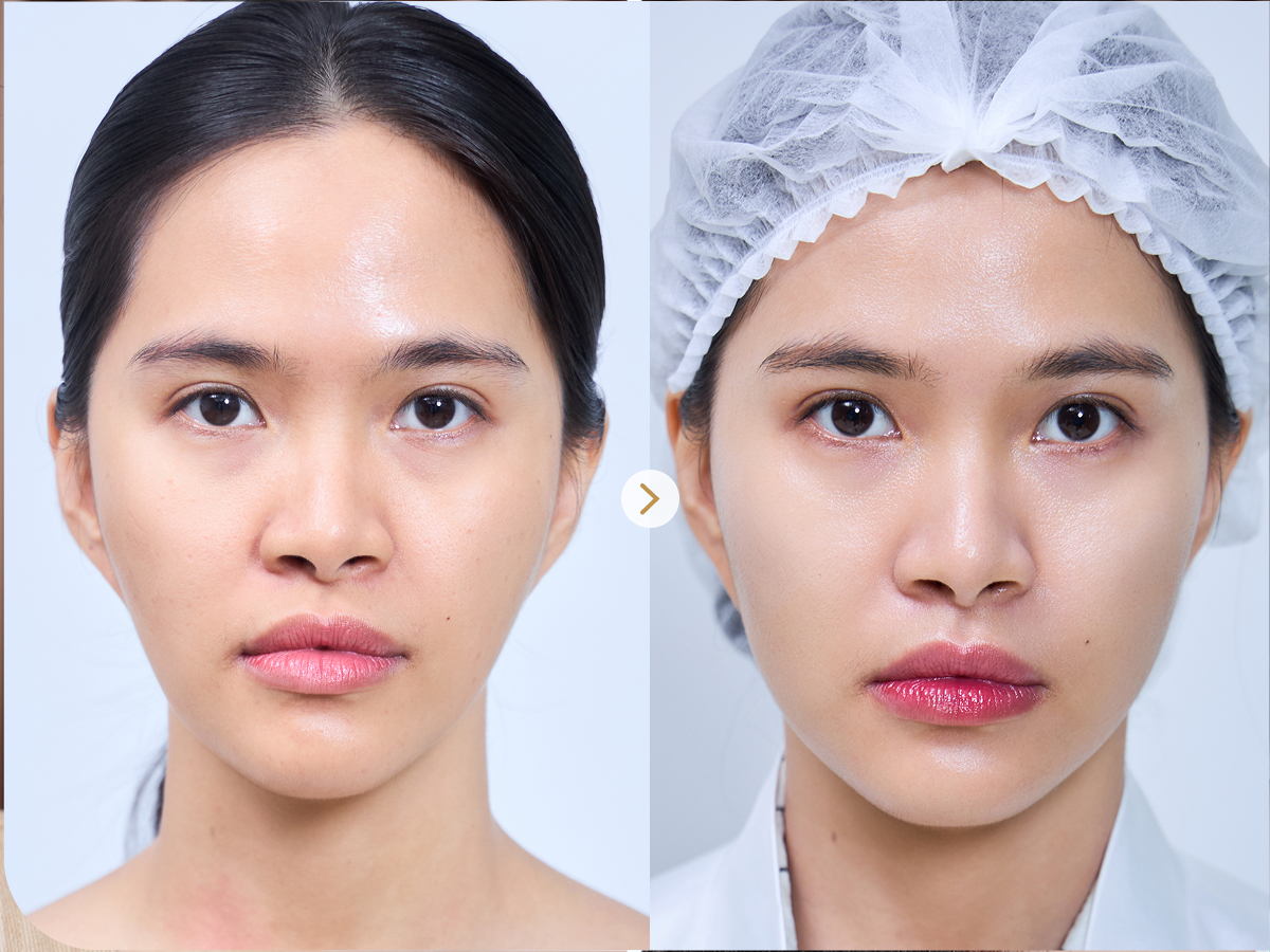 Trước và sau khi điều trị Làm đầy & xóa nhăn: Mai Anh, 38 tuổi