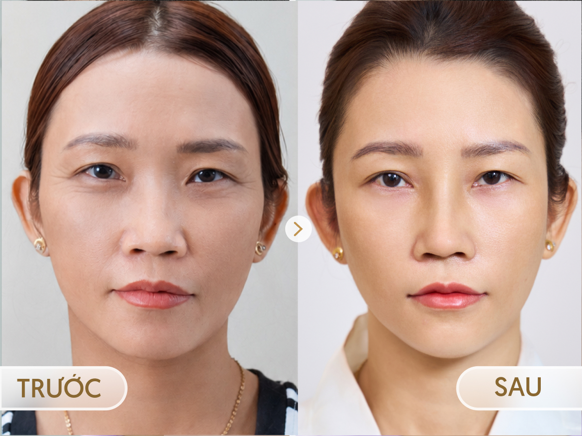 Trước và sau khi điều trị Làm đầy & xóa nhăn: Thuỳ Linh, 41 tuổi