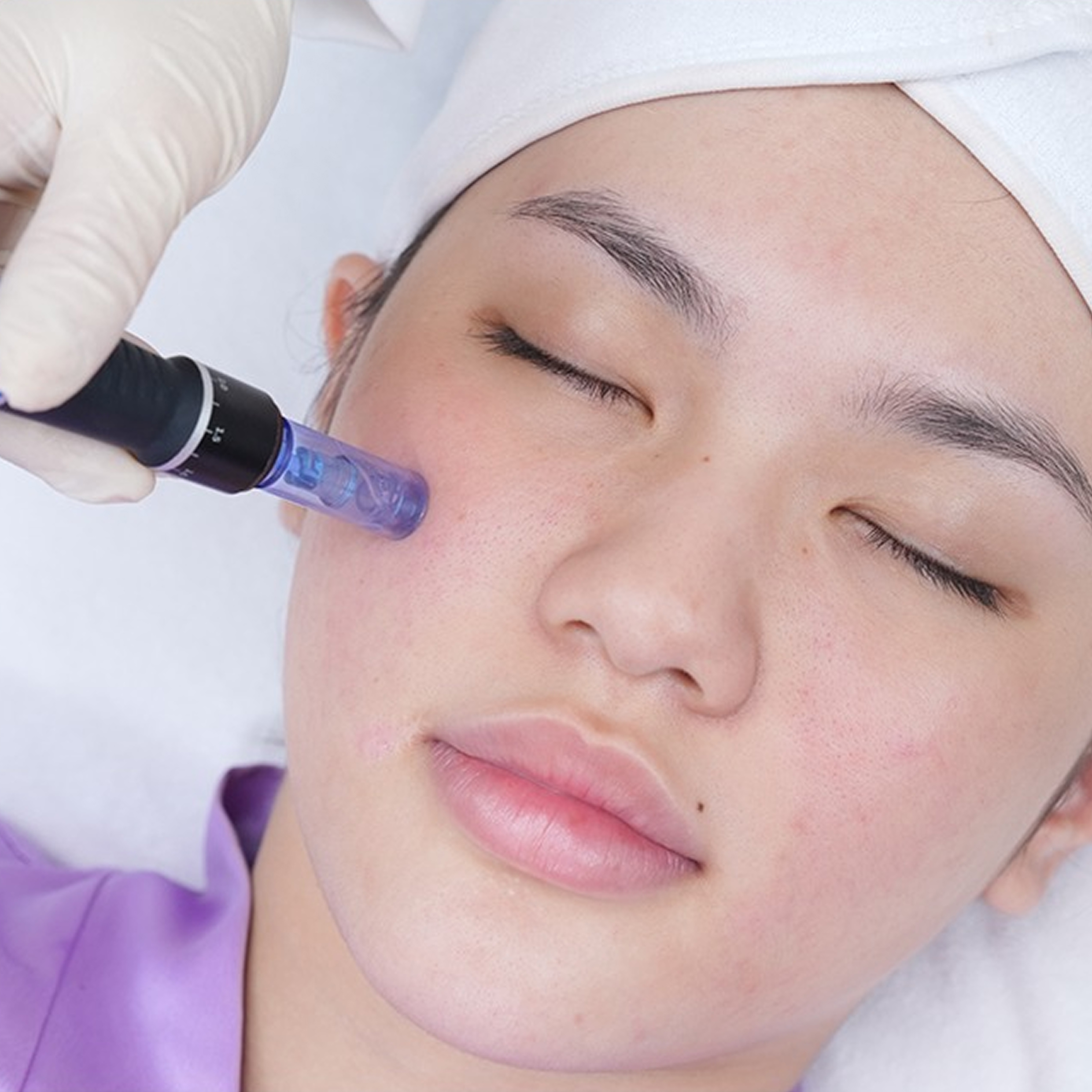 Mela - Zero tại Thẩm mỹ Linh Anh